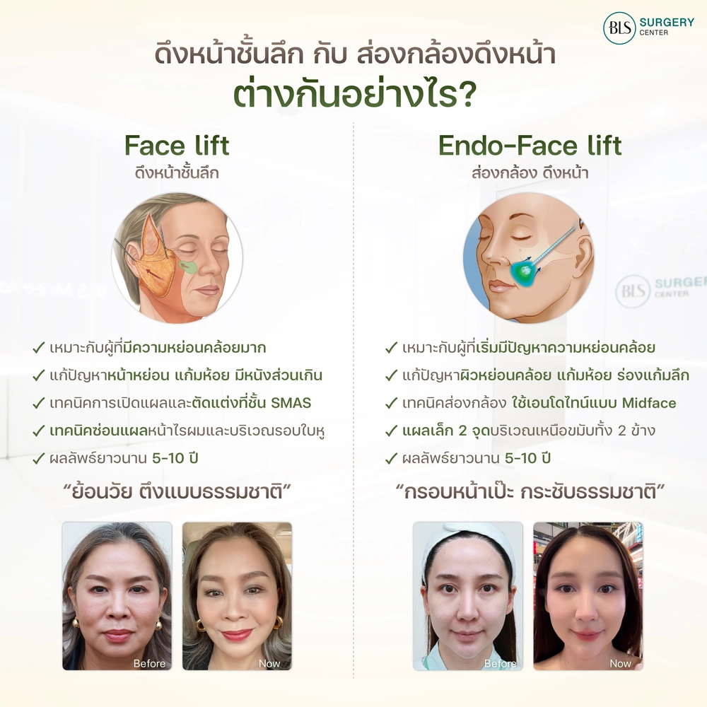 ส่องกล้อง ดึงหน้า Endo-Face-Lift กับ Facelift ยกกระชับใบหน้า ต่างกันอย่างไร?