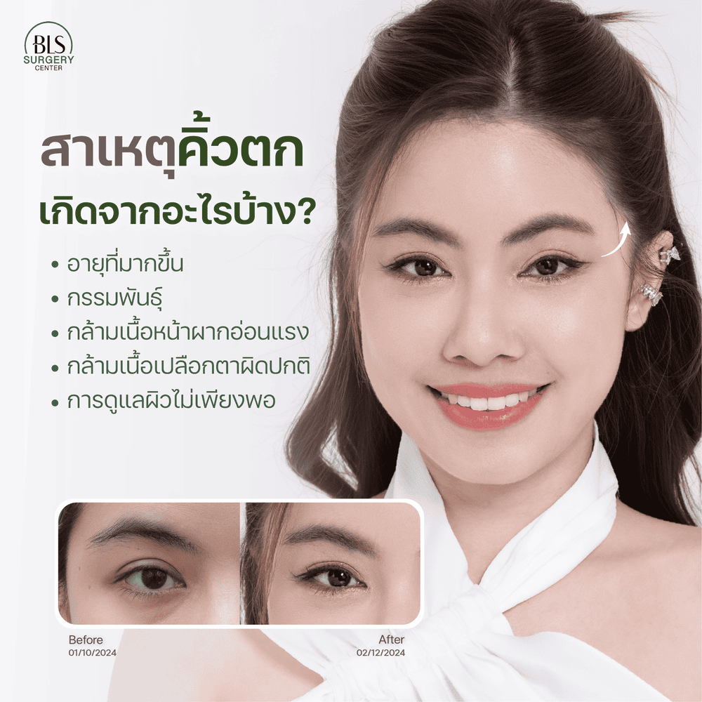 สาเหตุของคิ้วตก เกิดจากอะไร?  ส่งผลเสียอย่างไรต่อใบหน้า?