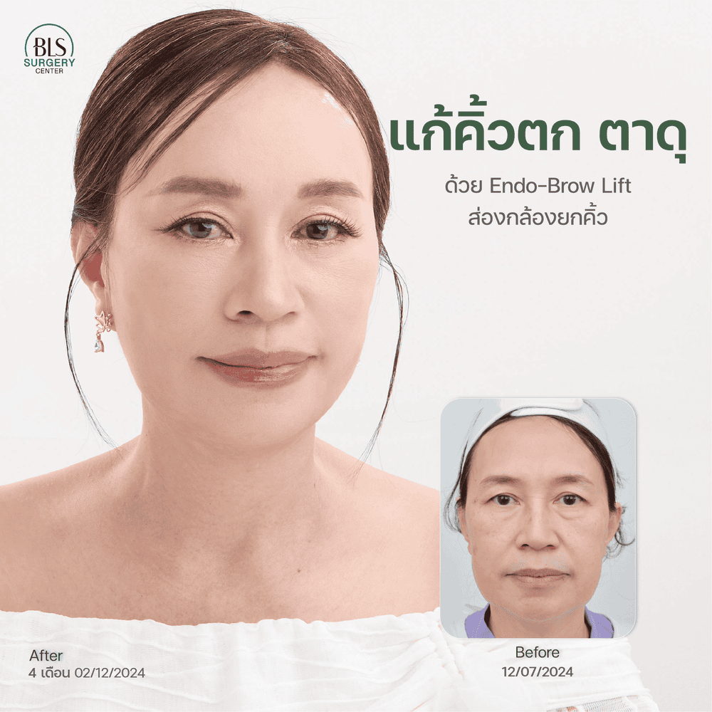 แก้คิ้วตก ตาดุ ด้วย Endo-Brow Lift ส่องกล้องยกคิ้ว