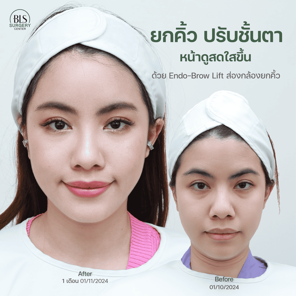 ผลลัพธ์ที่สัมผัสได้จากการทำ Endotine