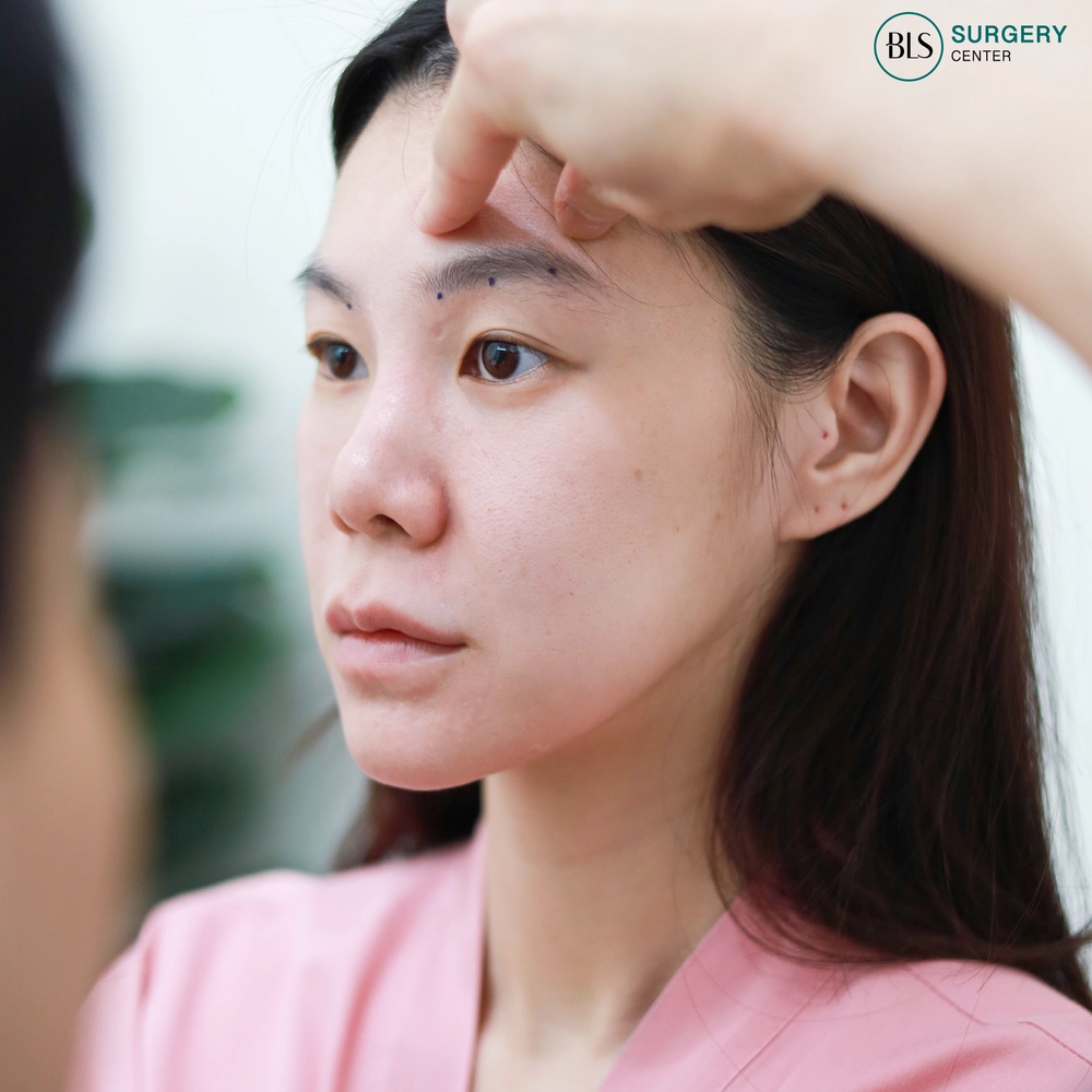 Steps of Endotine Brow Lift