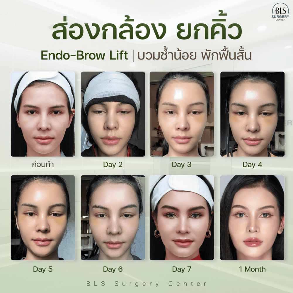 ผลลัพธ์หลังยกคิ้ว Endo-brow Lift แผลเข้าที่ ใช้เวลากี่วัน?