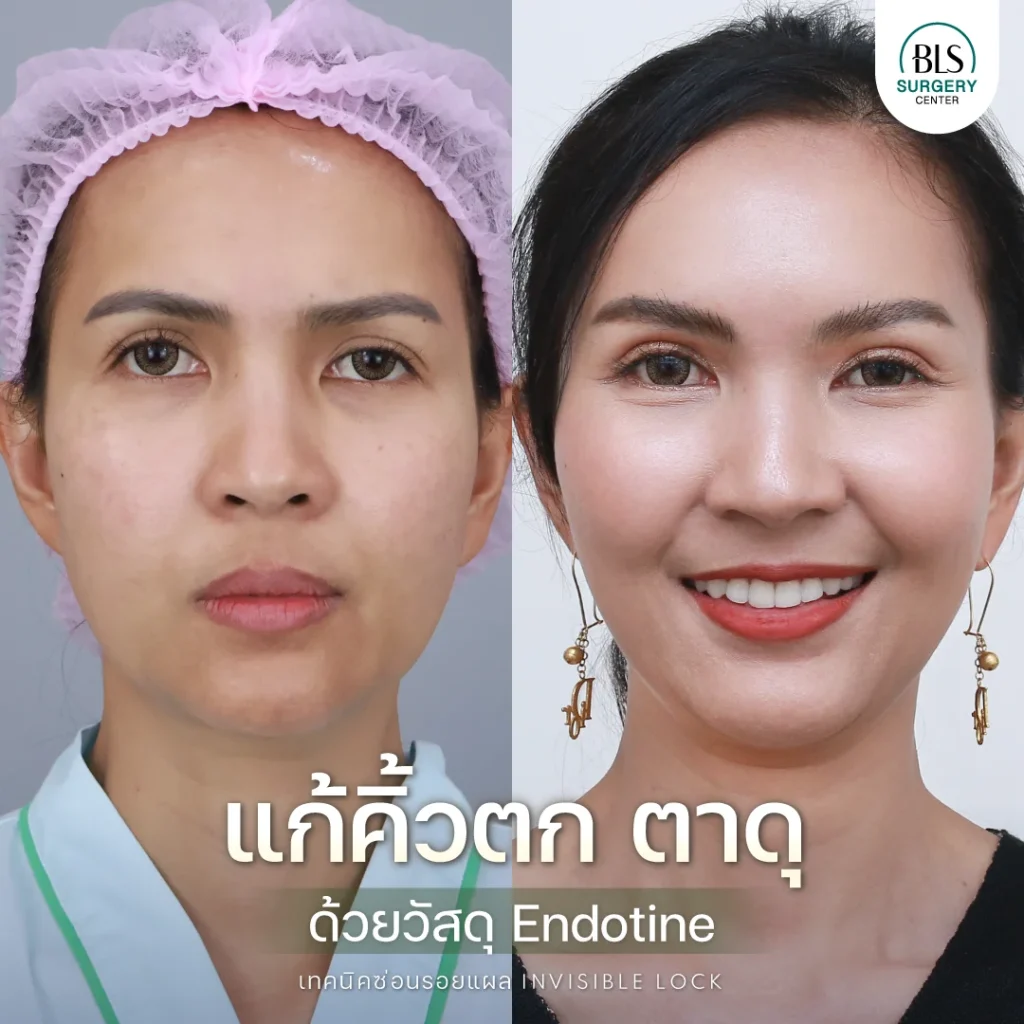 รีวิวจากลูกค้า แก้คิ้วตก ตาดุ ด้วยวัสดุ Endotine