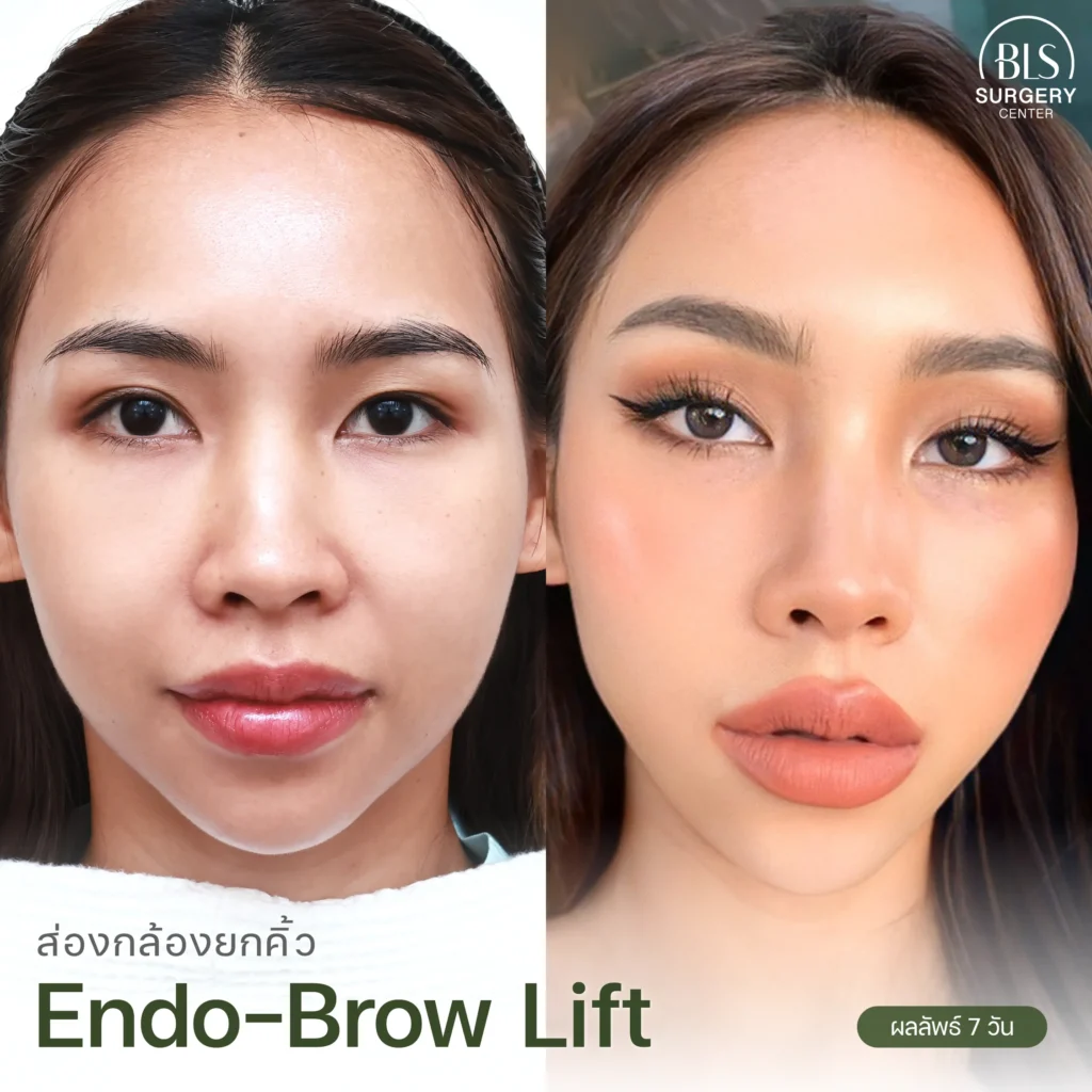 รีวิวจากลูกค้า ส่องกล้องยกคิ้ว Endo-Brow Lift