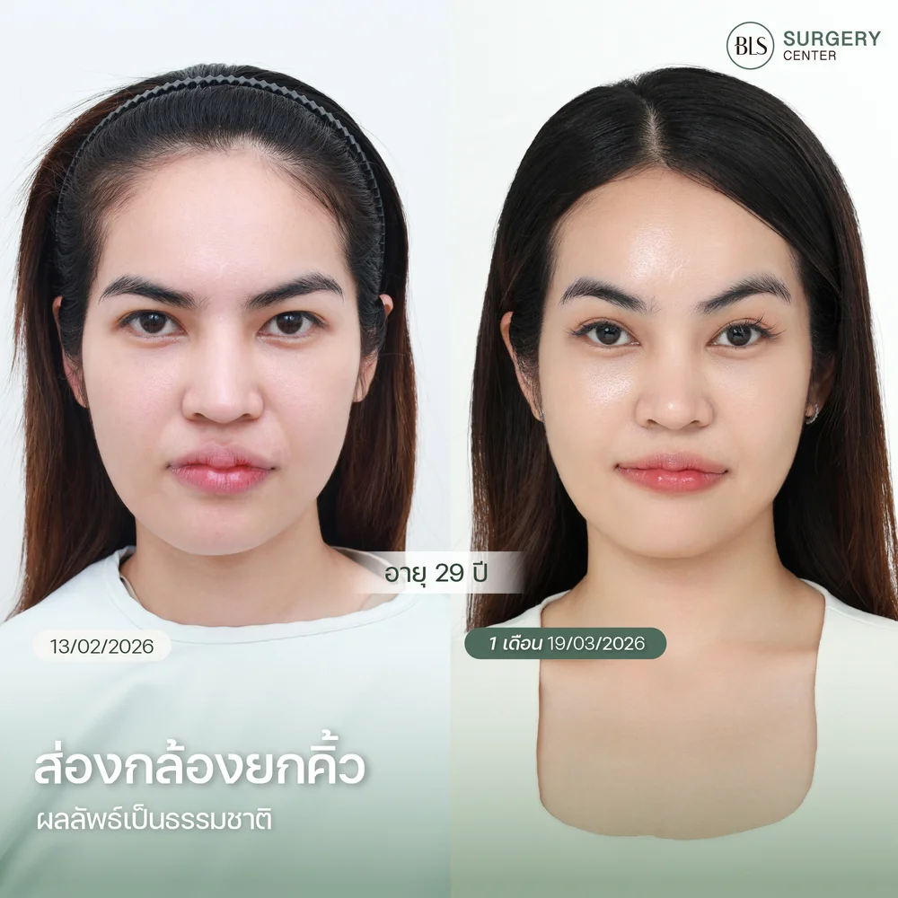 เคสส่องกล้องยกคิ้ว endotine รีวิวความสวย ดูเด็กลง