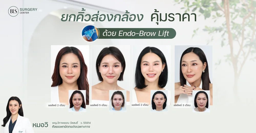 ยกคิ้วส่องกล้อง ราคาคุ้มค่า | ยกคิ้ว Endotine ที่ BLS Surgery Center