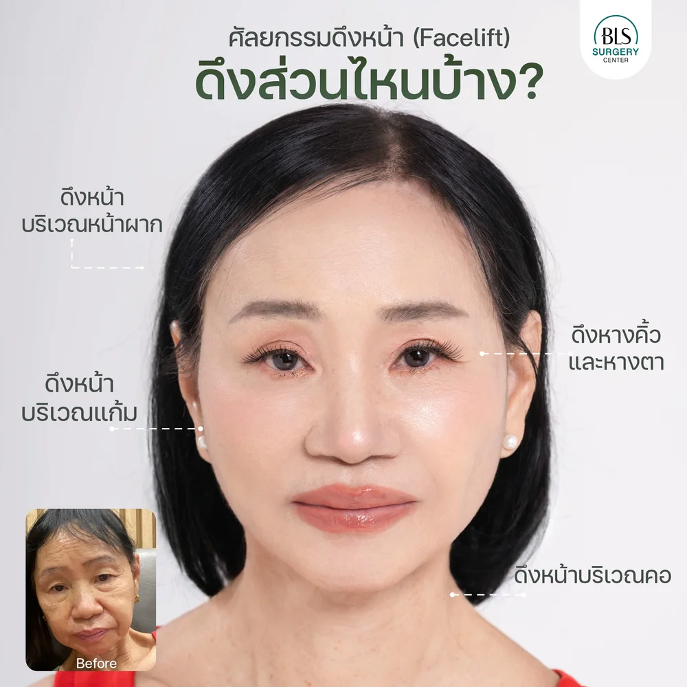 ศัลยกรรมดึงหน้า (Face Lift) ดึงส่วนไหนบ้าง?