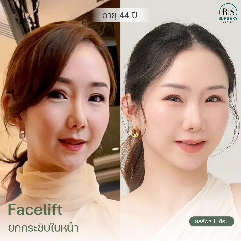 ดึงหน้า รีวิวสวยๆ จากคนไข้ BLS Surgery Center