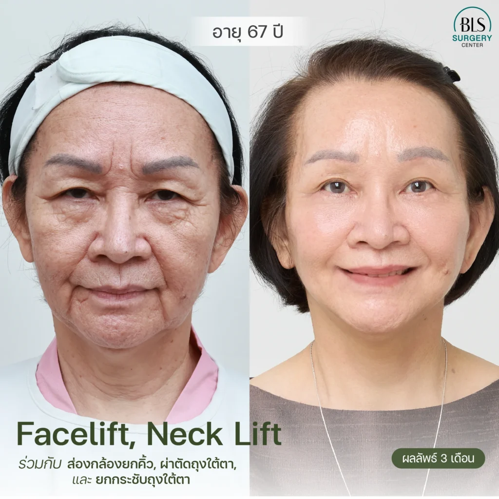 ดึงหน้า รีวิวสวยๆ จากคนไข้ BLS Surgery Center