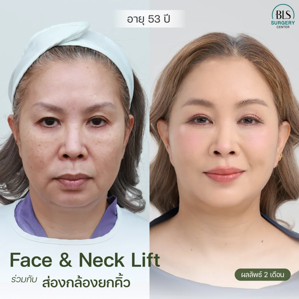 ดึงหน้า รีวิวสวยๆ จากคนไข้ BLS Surgery Center