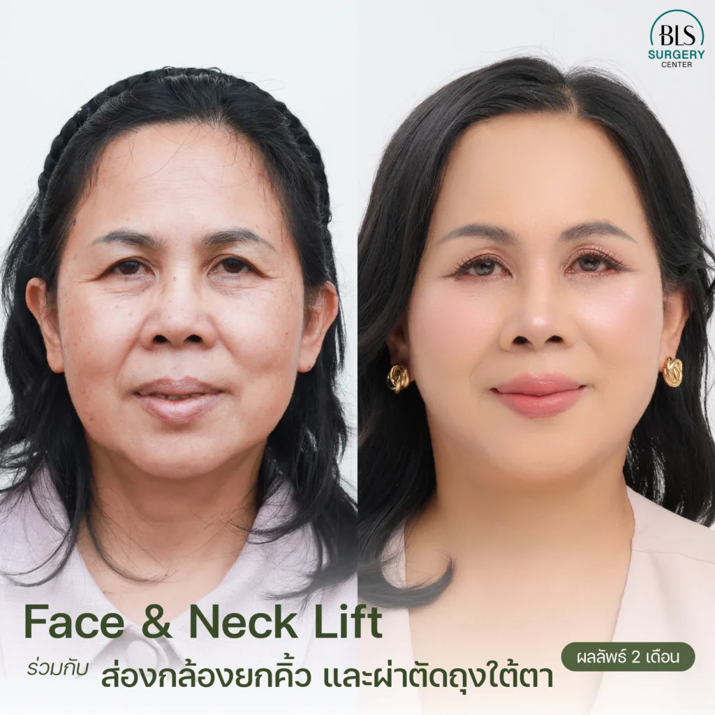 ดึงหน้า รีวิวสวยๆ จากคนไข้ BLS Surgery Center