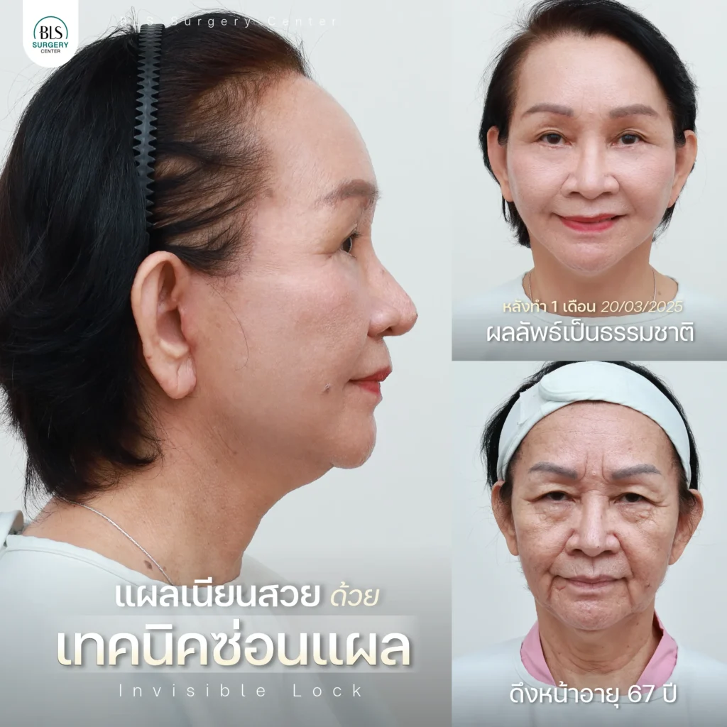 ดึงหน้า รีวิวสวยๆ จากคนไข้ BLS Surgery Center