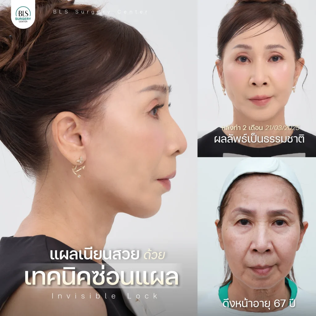 ดึงหน้า รีวิวสวยๆ จากคนไข้ BLS Surgery Center