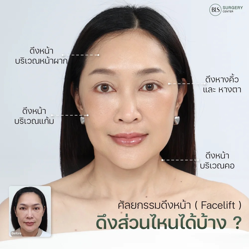 ศัลยกรรมดึงหน้า (Face Lift) ดึงส่วนไหนบ้าง?