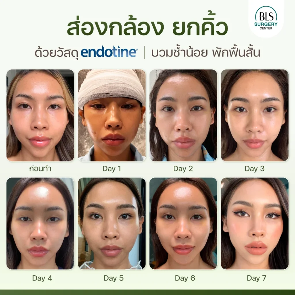 Timeline การเข้าที่ หลังส่องกล้องยกคิ้ว Endo-Brow Lift | เอนโดไทน์ (Endotine)