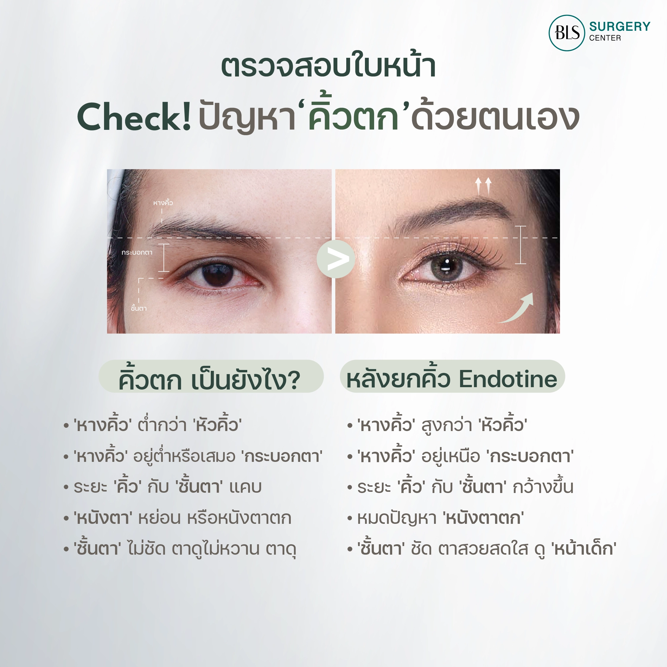 ลักษณะคิ้วแบบไหน? เข้าข่าย 'ภาวะคิ้วตก'