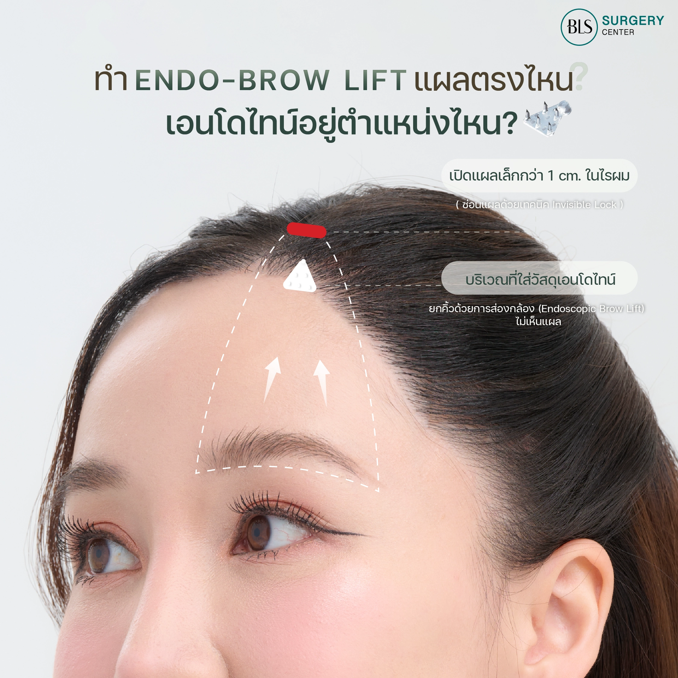 Endotine ยกคิ้วส่องกล้อง ตอบโจทย์ปัญหาคิ้วตก