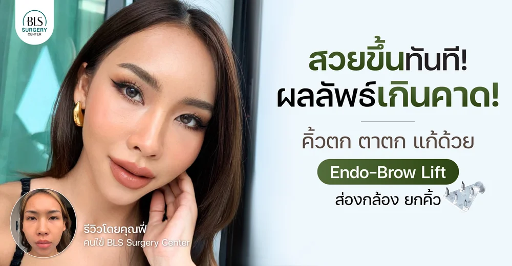 ประสบการณ์ยกคิ้ว เอนโดไทน์ (Endo-Brow lift) “ รีวิวโดย คุณฟี่”