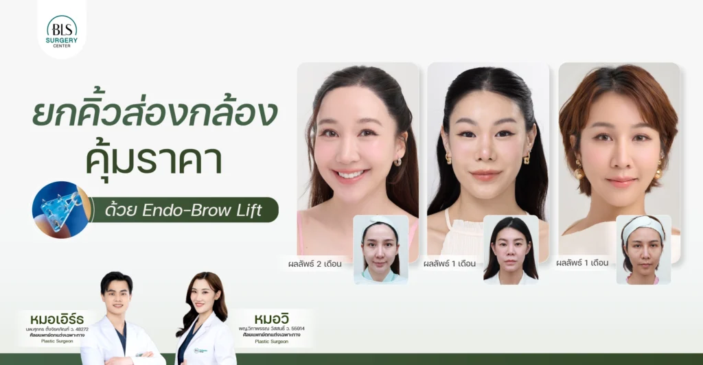 ยกคิ้วส่องกล้อง ราคาคุ้มค่า | ยกคิ้ว Endotine ที่ BLS Surgery Center