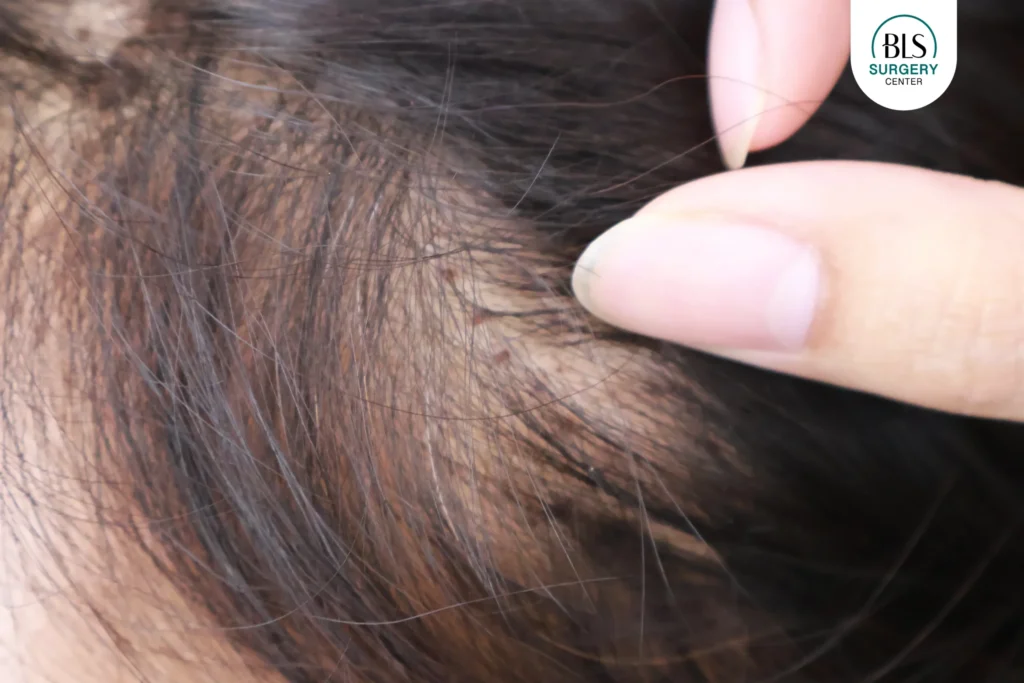 Post-surgery scars – almost invisible with Invisible Lock technique