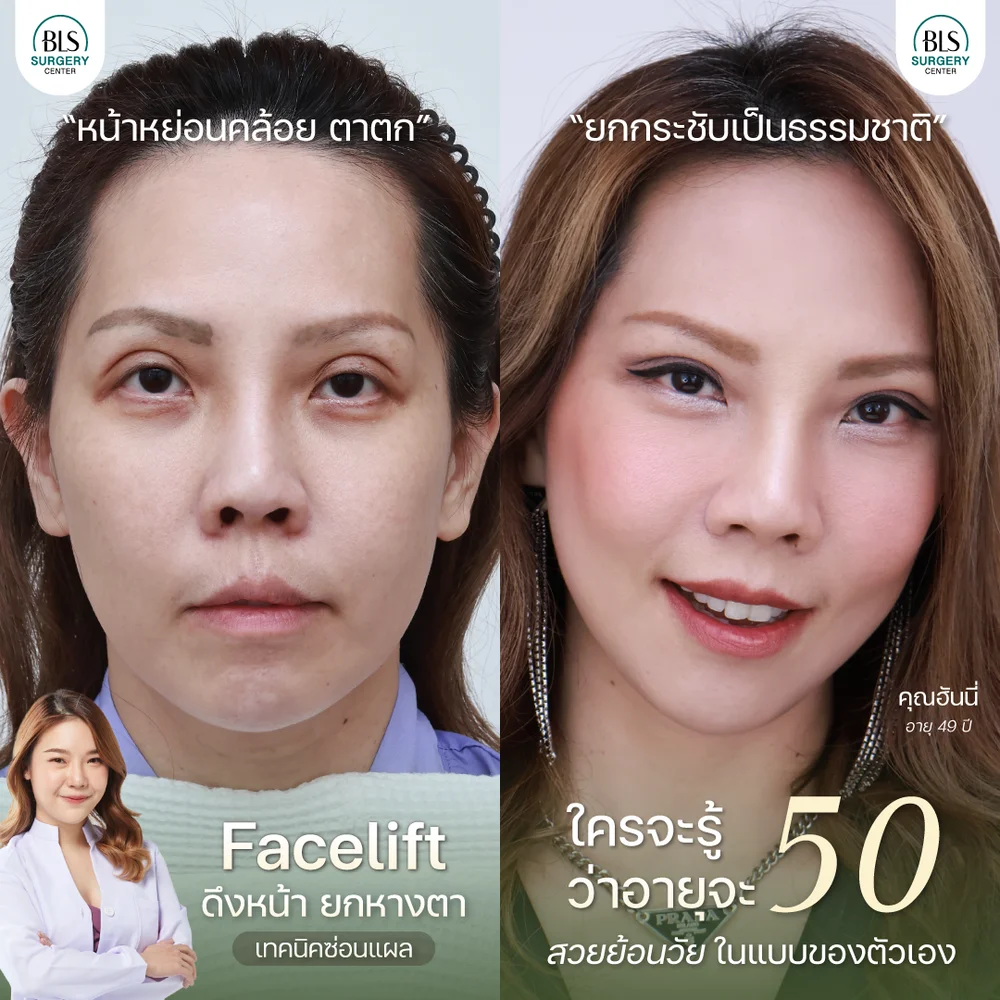 หมอบีม Facelift ดึงหน้า