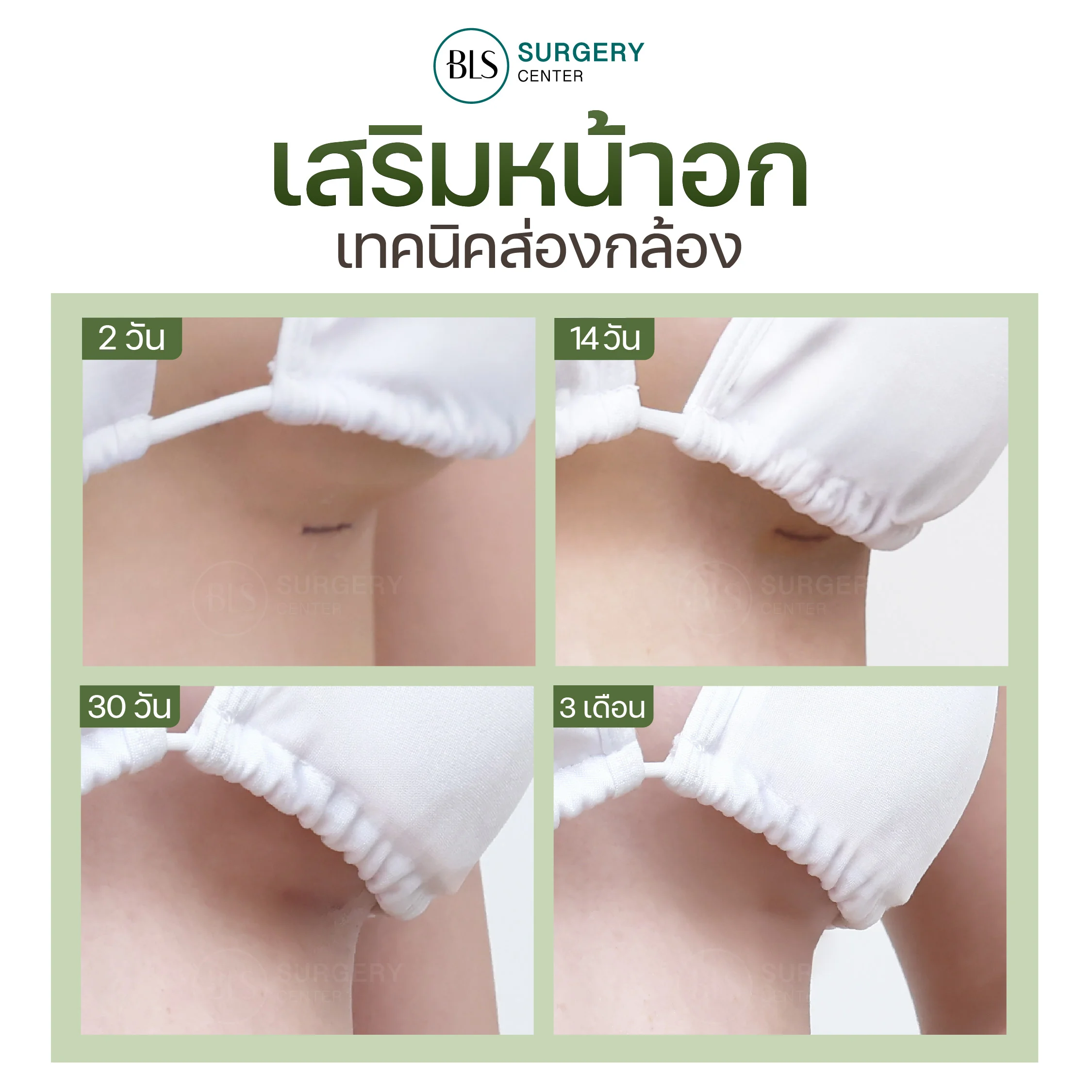 Timeline การเข้าที่ของแผลเสริมหน้าอก
| เสริมหน้าอกที่ไหนดี ?