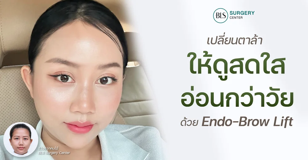เปลี่ยนตาล้า รอยขมวดคิ้ว ให้ดูสดใส อ่อนกว่าวัย ด้วย Endo-Brow Lift