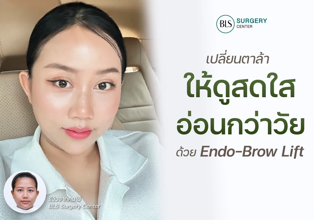 เปลี่ยนตาล้า รอยขมวดคิ้ว ให้ดูสดใส อ่อนกว่าวัย ด้วย Endo-Brow Lift