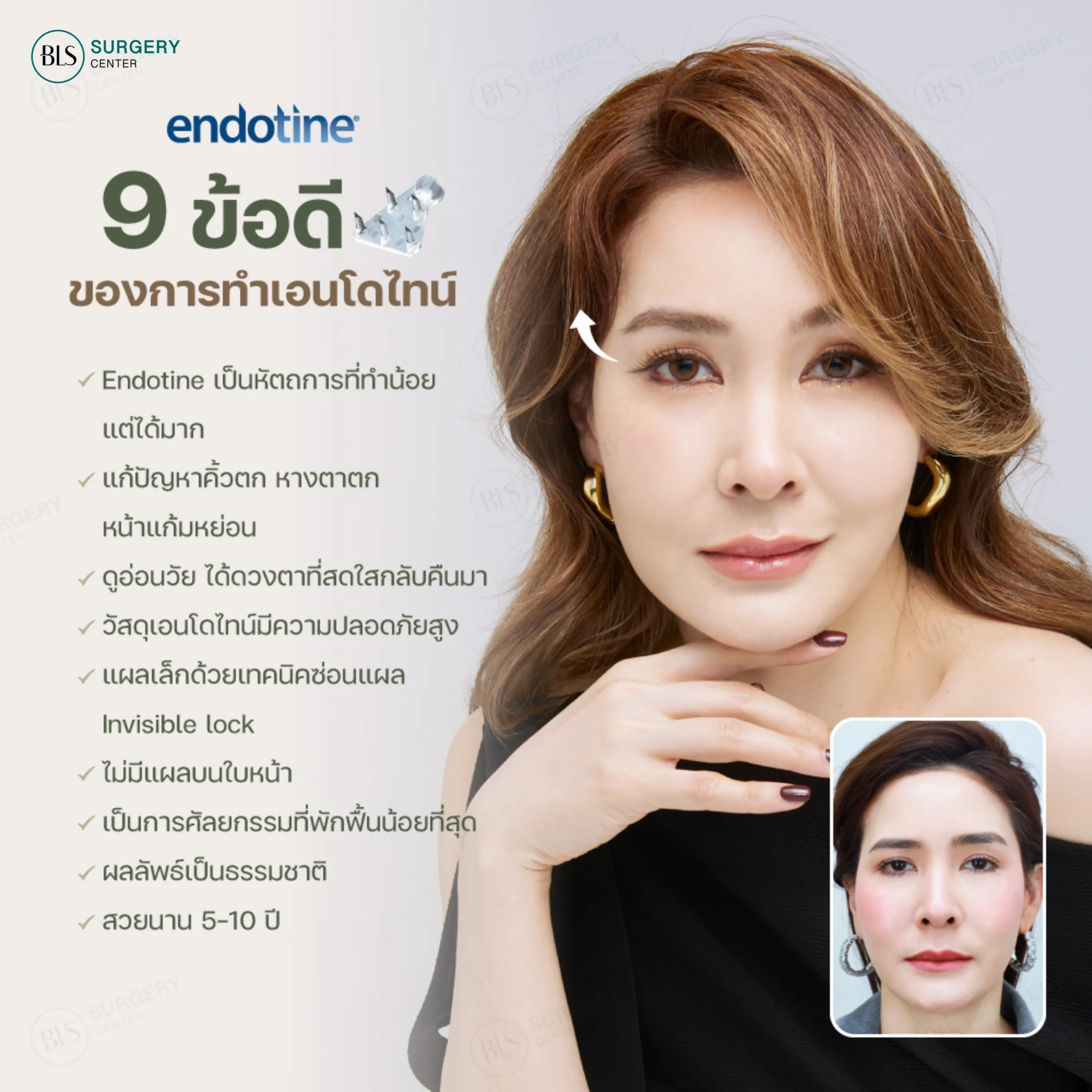  ข้อดีของการทำเอนโดไทน์