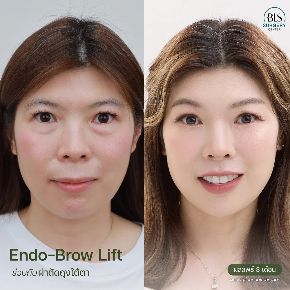 แก้คิ้วตก ถุงใต้ตา ด้วย Endo-Brow Lift ร่วมกับศัลยกรรมถุงใต้ตา