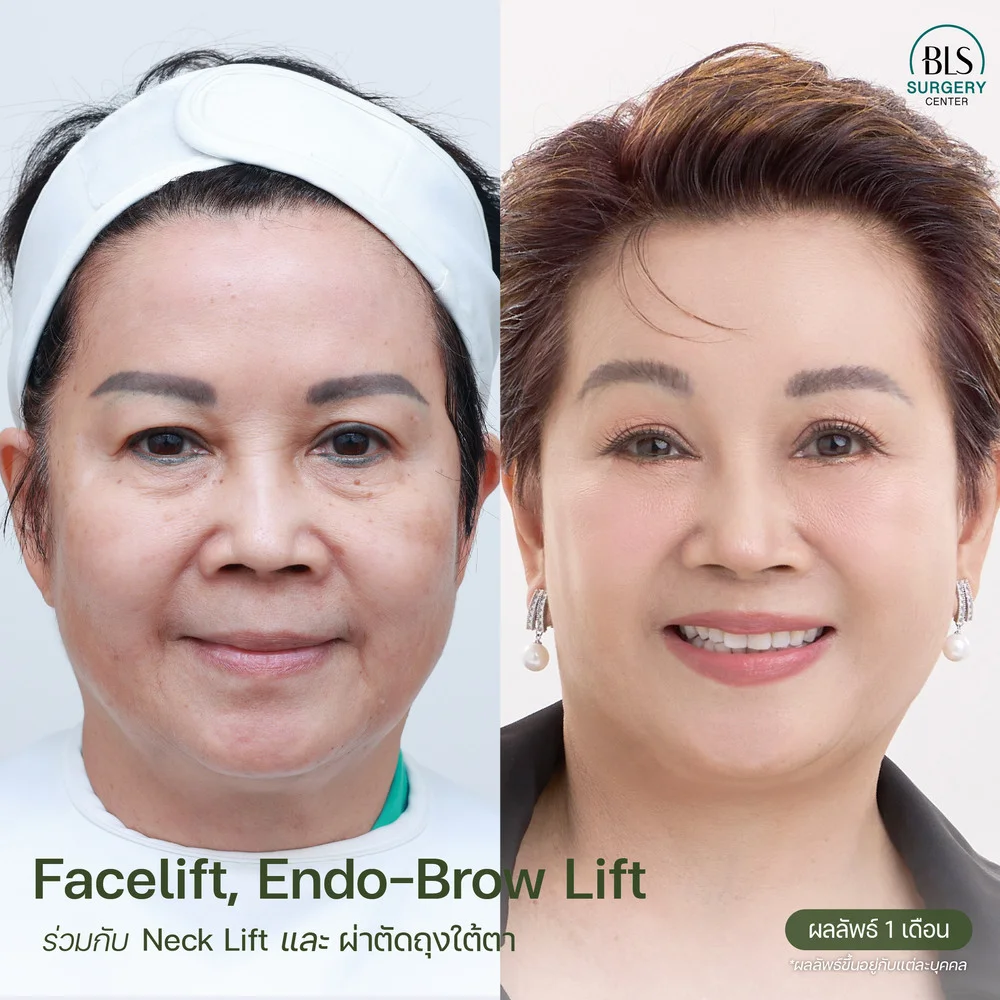 Endo-Brow Lift ส่องกล้องยกคิ้ว ร่วมกับ Face Lift Neck Lift และ Eye Bags