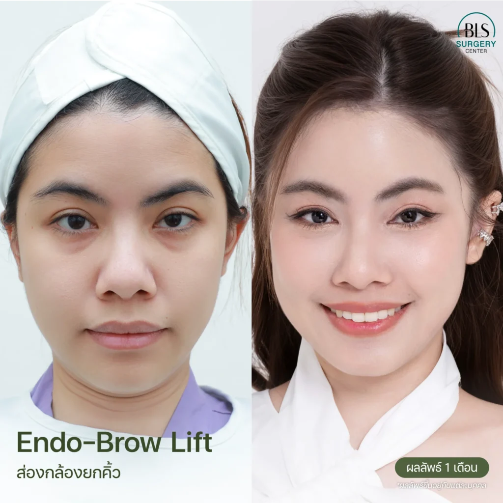 รีวิว ส่องกล้องยกคิ้ว Endo-Brow Lift ที่ BLS Surgery Center