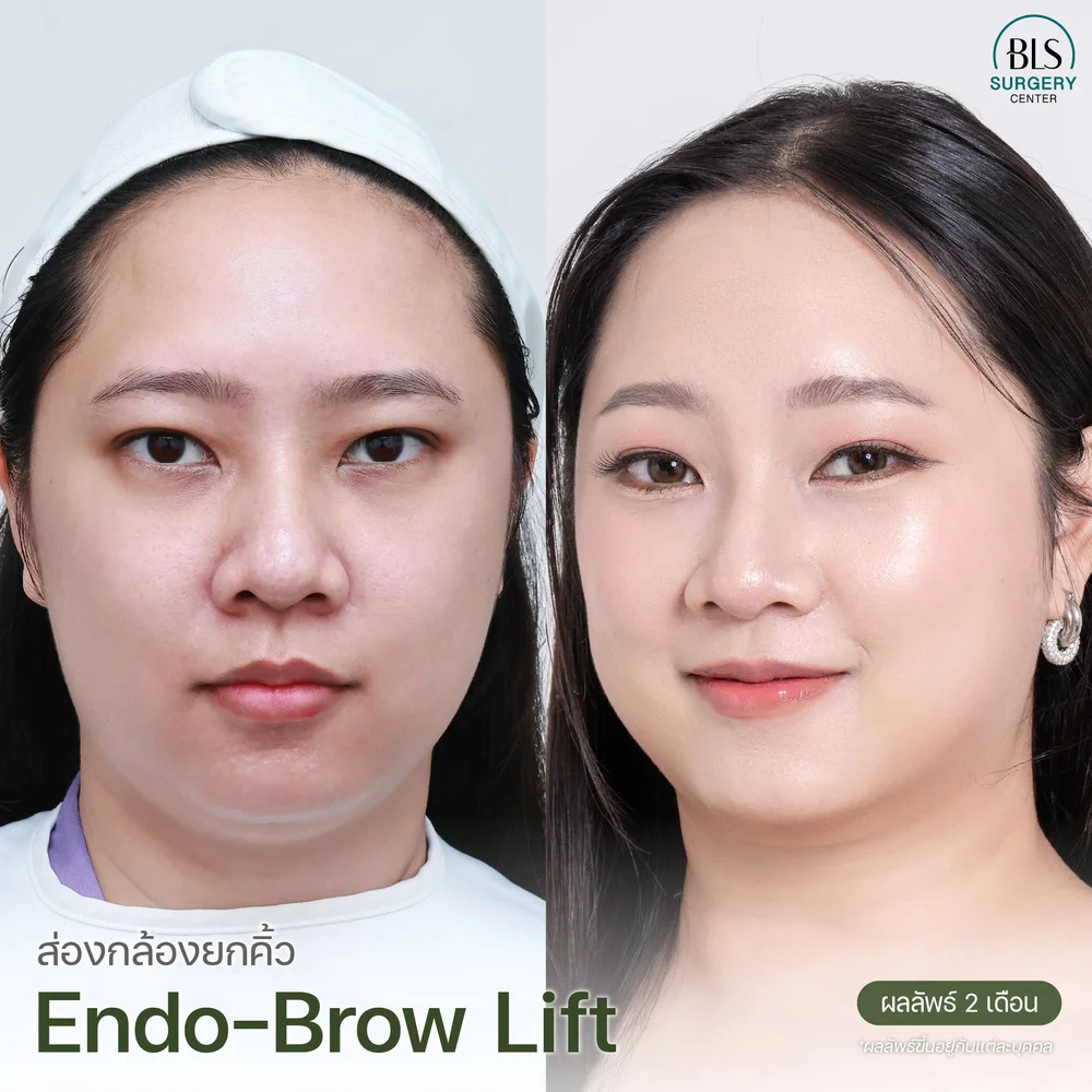 ส่องกล้องยกคิ้ว Endo-Brow Lift แก้ปัญหาชั้นตาแคบ