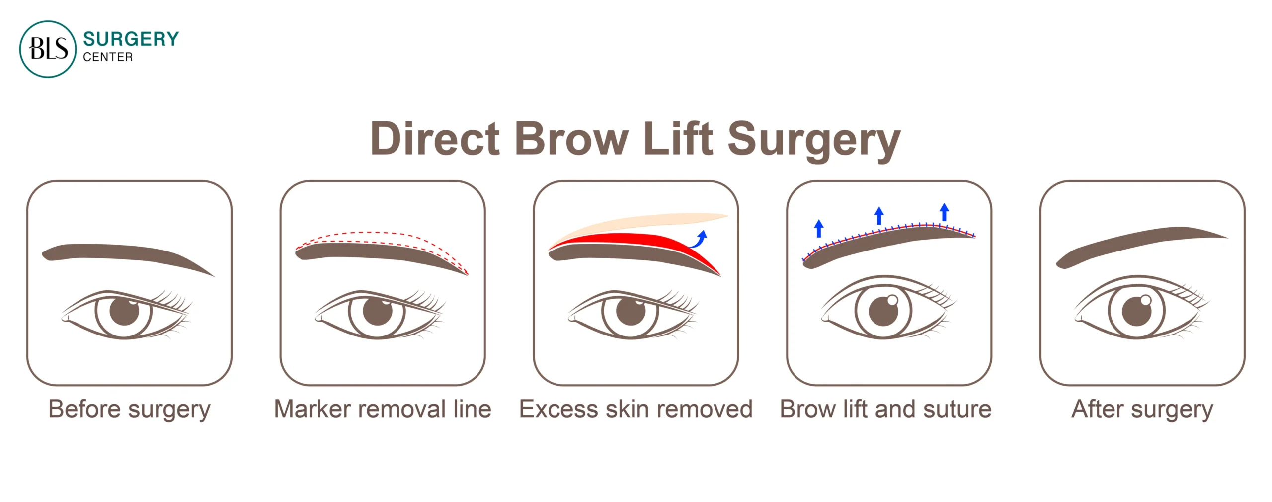 การยกคิ้วแบบทั่วไปด้วยเทคนิค Direct Brow Lift