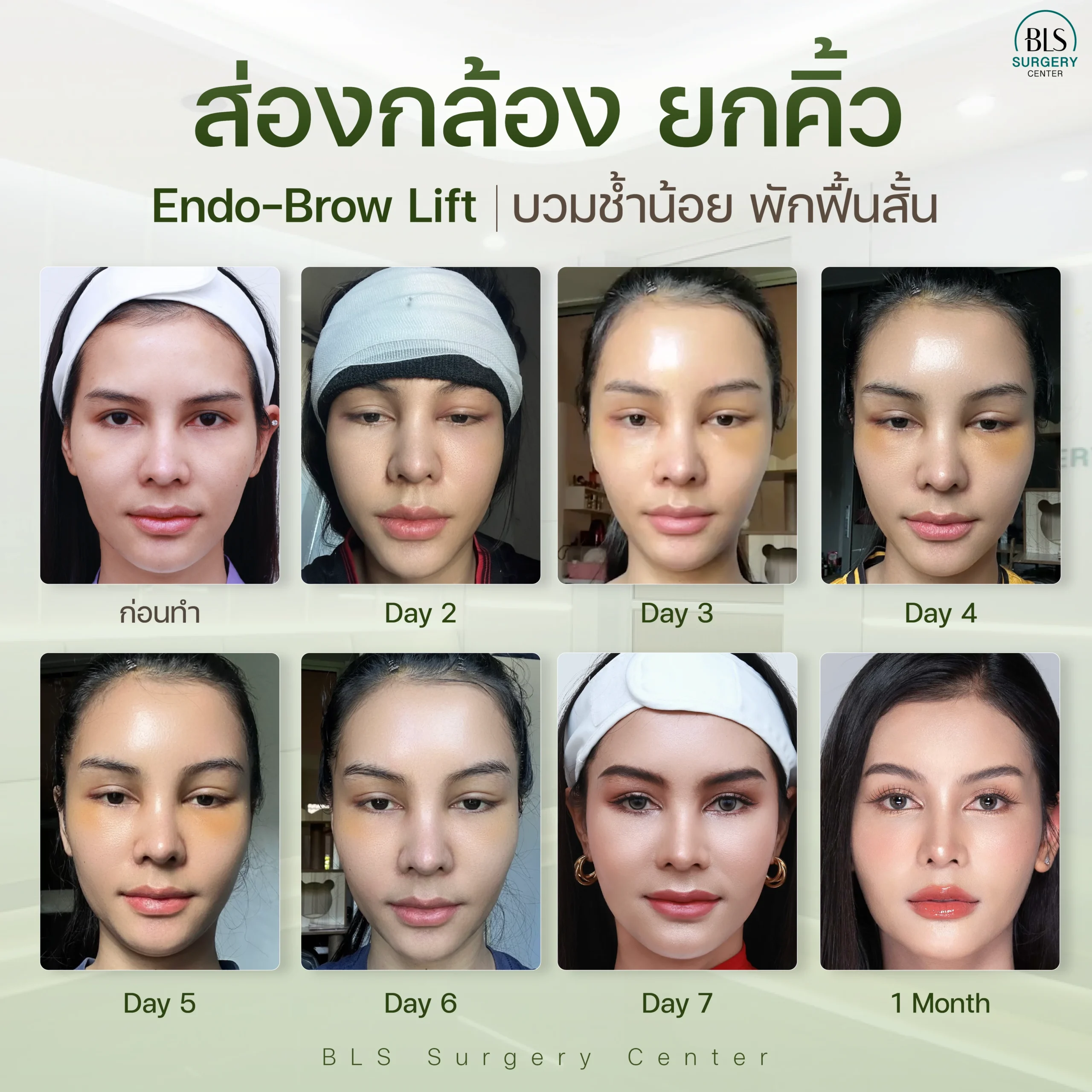 ยกคิ้ว พักกี่วัน?
