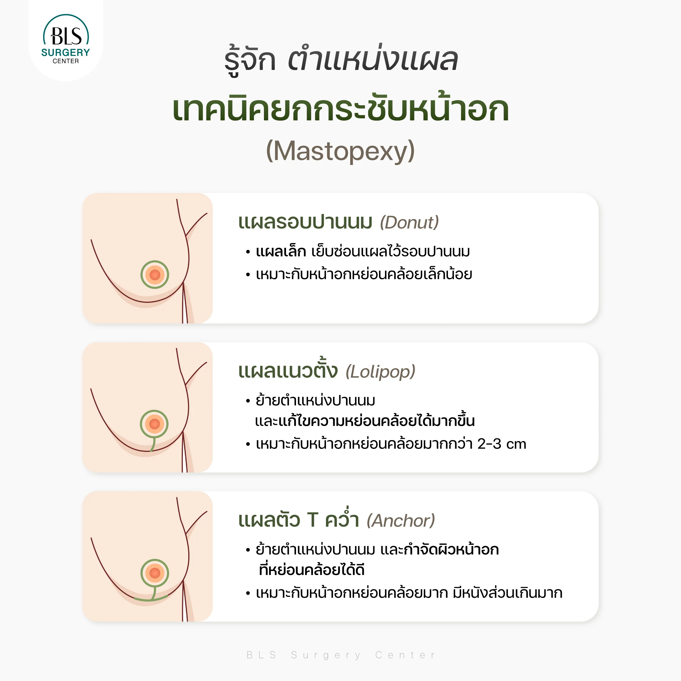 ตำแหน่งแผลของแต่ละเทคนิคยกกระชับหน้าอก (Mastopexy)