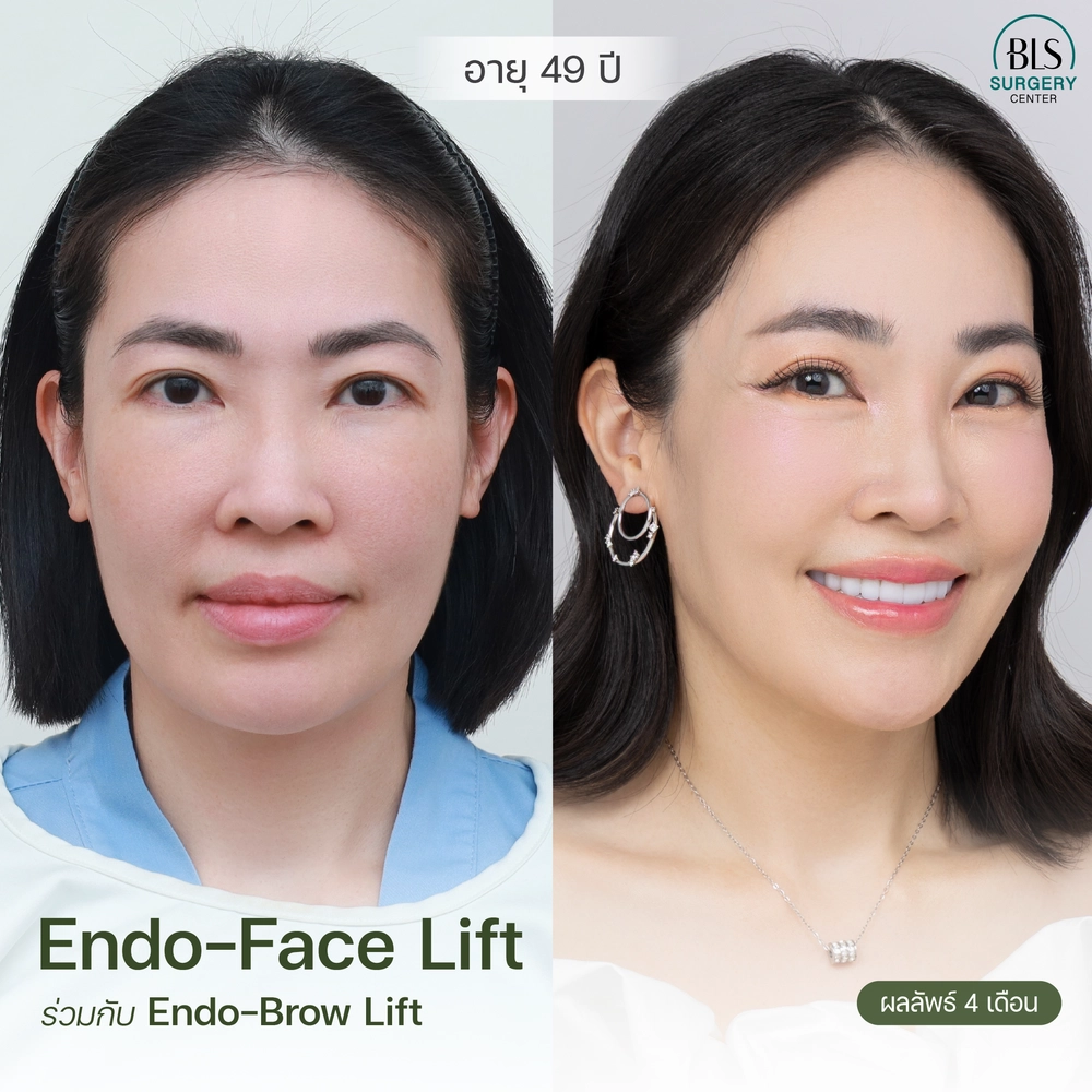 ชมเคสรีวิว ทำเอนโดไทน์ ยกคิ้ว Endo-Brow lift สวยๆ ที่ BLS Surgery Center