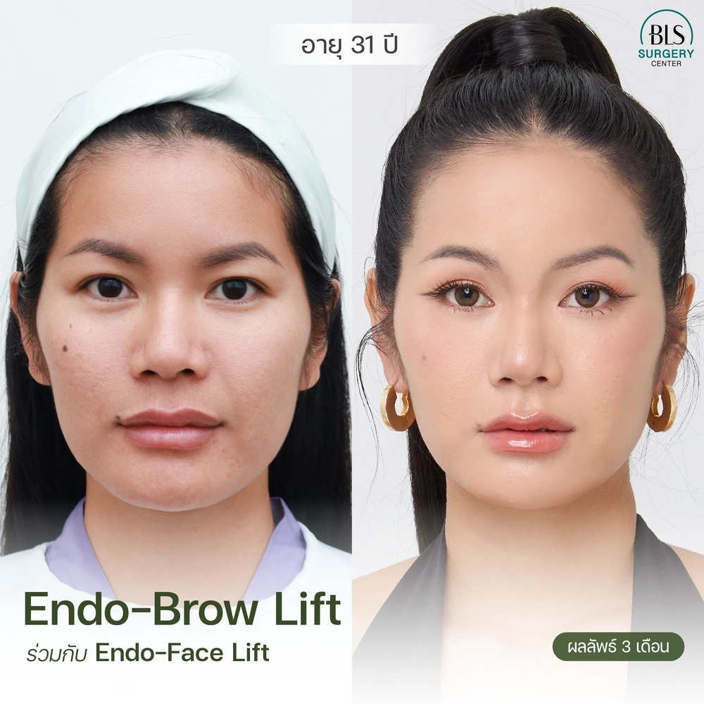 ชมเคสรีวิว ทำเอนโดไทน์ ยกคิ้ว Endo-Brow lift สวยๆ ที่ BLS Surgery Center