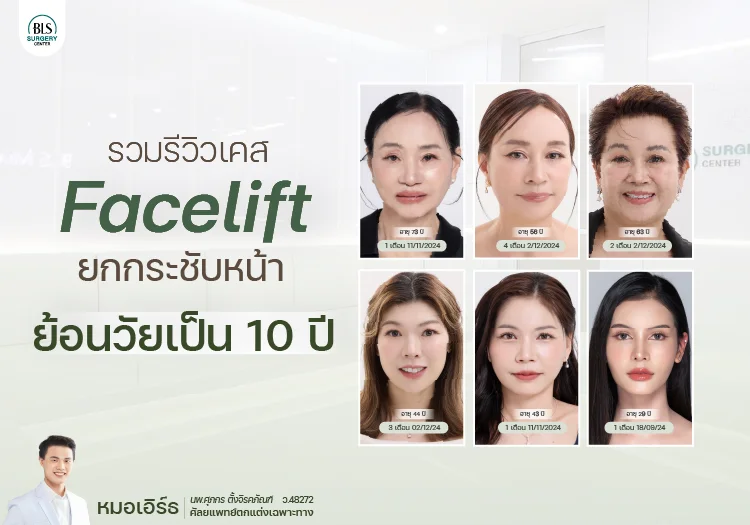 รวมรีวิวเคส Face Lift ยกกระชับหน้า ย้อนวัยเป็น 10 ปี โดยหมอเอิร์ธ