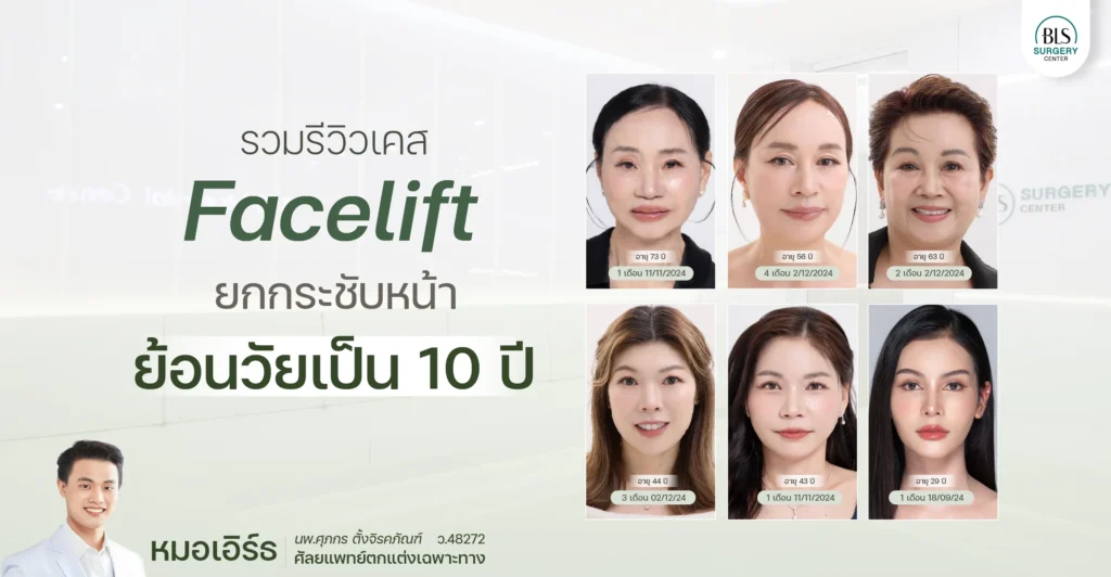 รวมรีวิวเคส Face Lift ยกกระชับหน้า ย้อนวัยเป็น 10 ปี โดยหมอเอิร์ธ