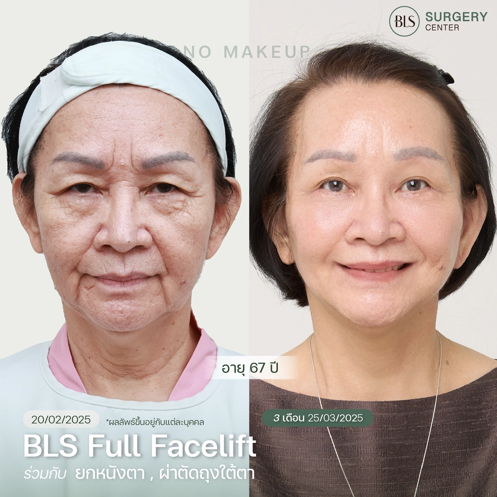 ชมเคสรีวิว ทำ Face lift ศัลยกรรมดึงหน้า ให้อ่อนเยาว์ ที่ BLS Surgery Center