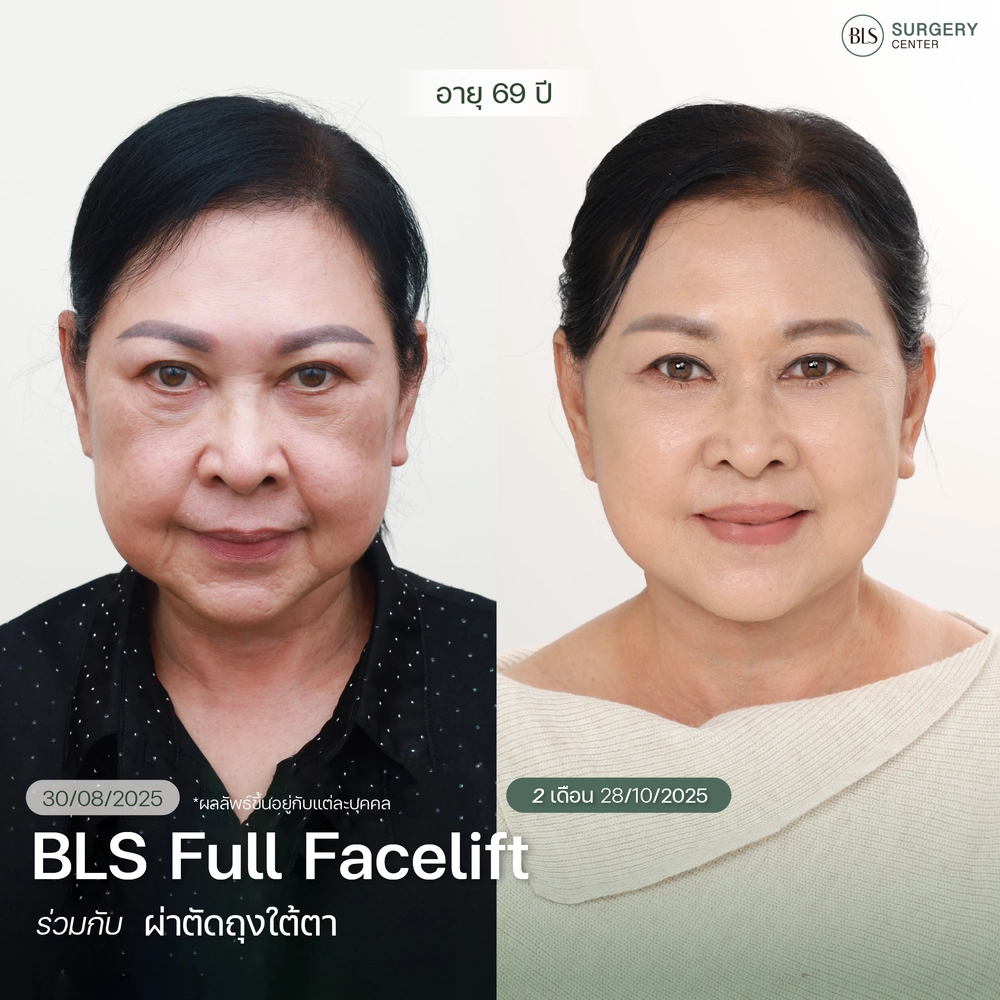 ชมเคสรีวิว ทำ Face lift ศัลยกรรมดึงหน้า ให้อ่อนเยาว์ ที่ BLS Surgery Center