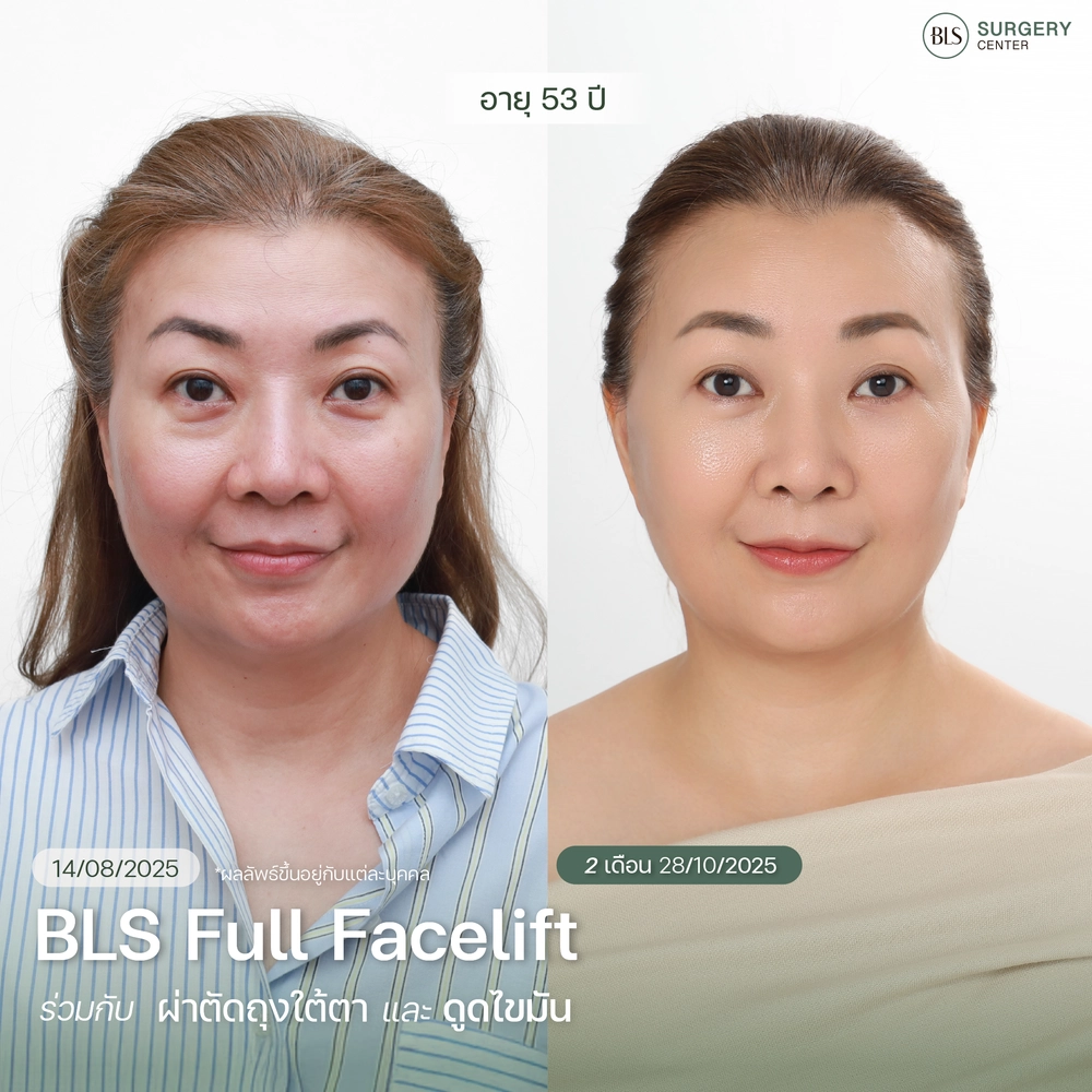 ชมเคสรีวิว ทำ Face lift ศัลยกรรมดึงหน้า ให้อ่อนเยาว์ ที่ BLS Surgery Center