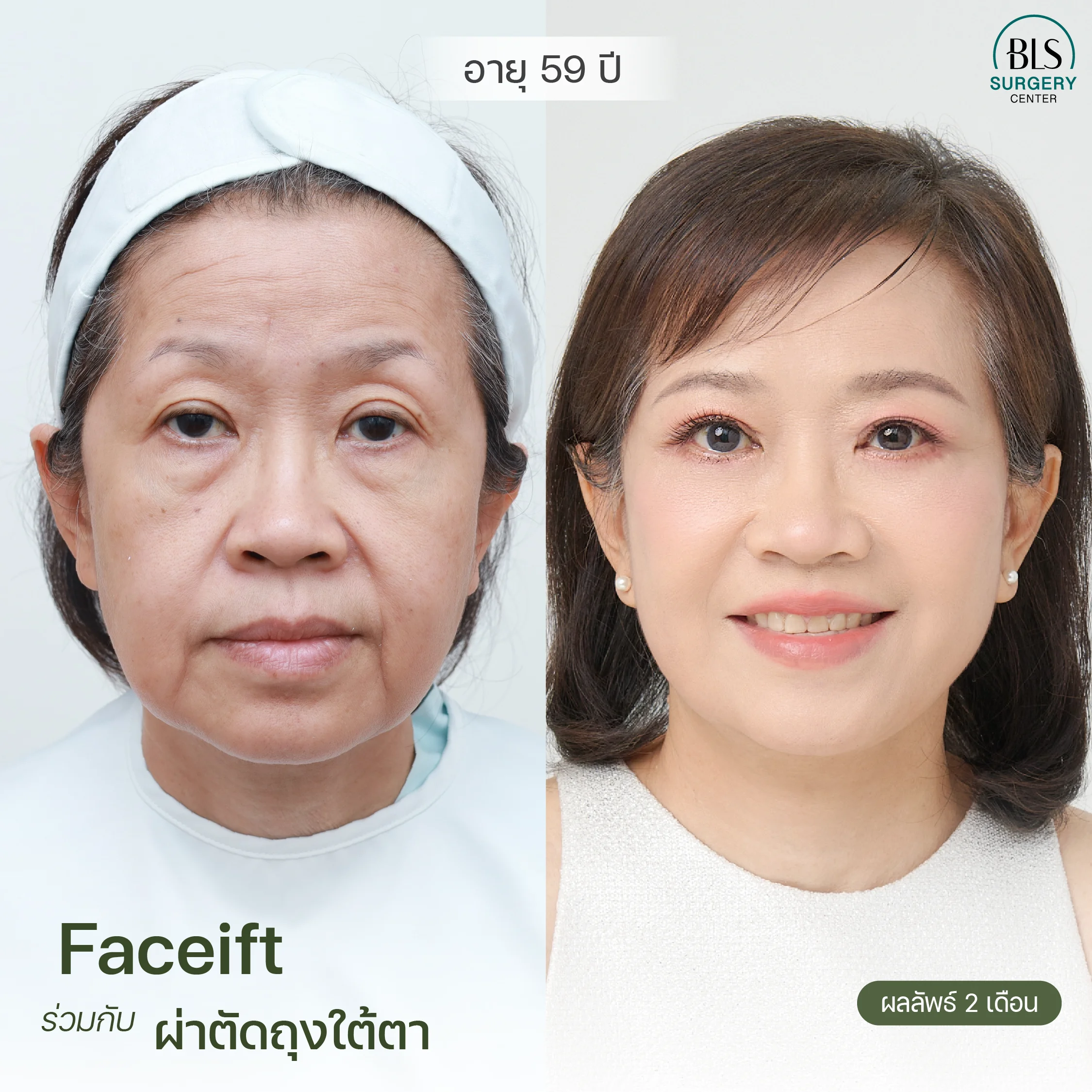 แก้ปัญหาหนังตาตก มีถุงใต้ตา ใบหน้า ลำคอมีรอยย่น ด้วย Face Lift | ยกกระชับหน้า