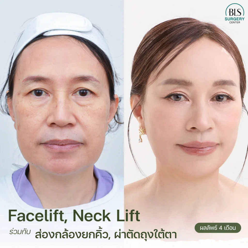 แก้ปัญหาหางตาตก ใต้ตาหย่อน แก้มหย่อนคล้อย ด้วย Face Lift