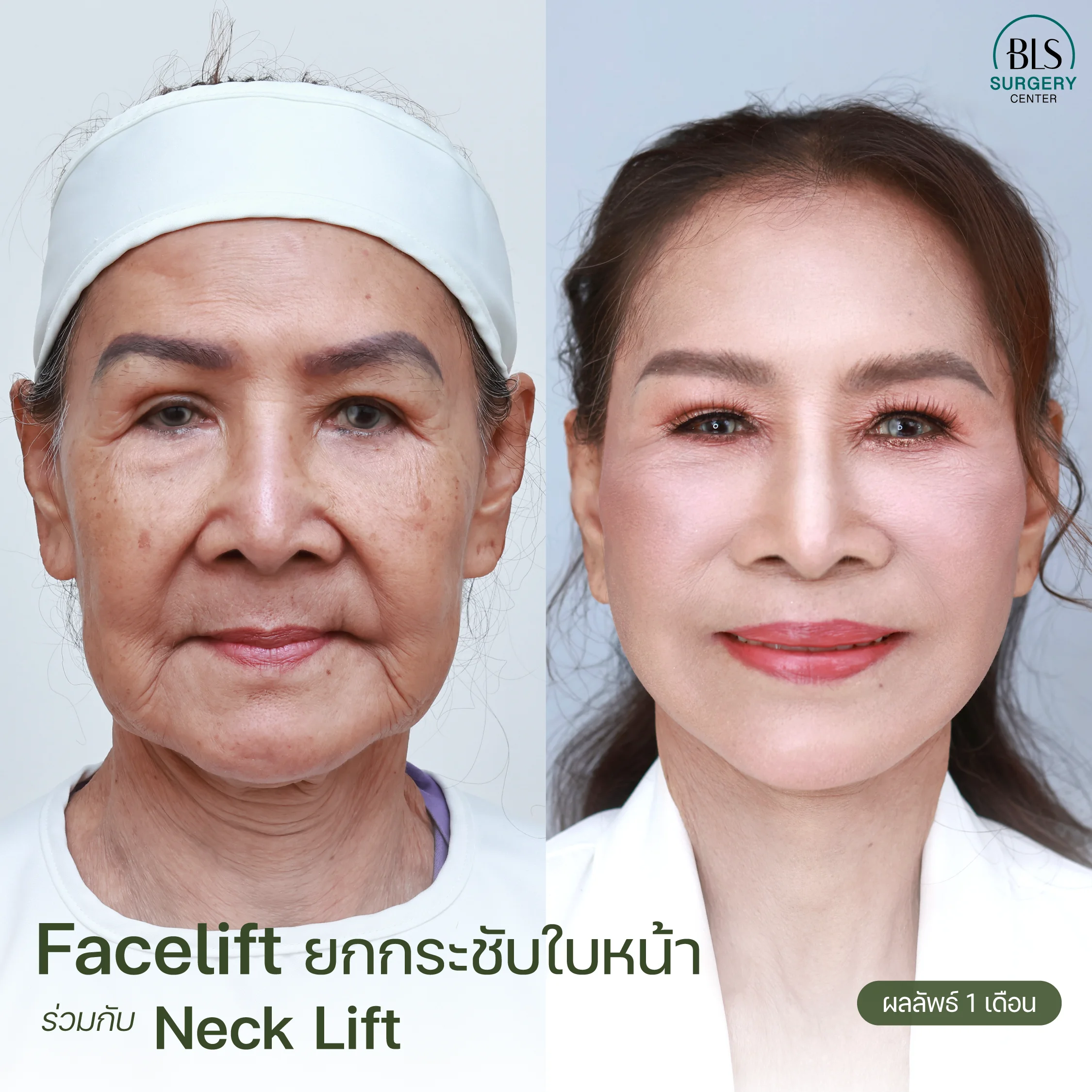 แก้ปัญหาแก้มห้อย ร่องแก้มชัด และคอไม่กระชับ ด้วย Face Lift | ยกกระชับหน้า