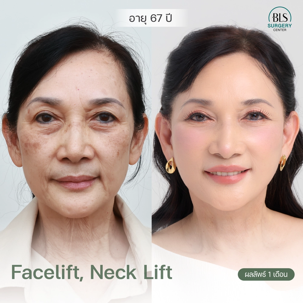 แก้ปัญหาใบหน้าหย่อนคล้อย หางตาตก ดวงตาดูง่วงนอน ด้วย Face Lift