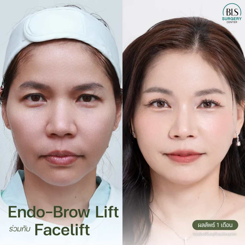 แก้ปัญหาใบหน้าหย่อนคล้อย หางตาตก ดวงตาดูง่วงนอน ด้วย Face Lift