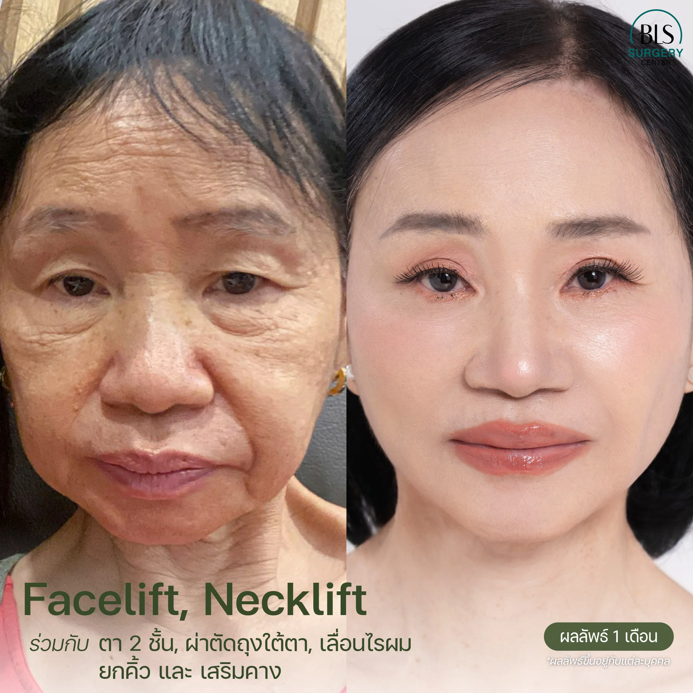 แก้ปัญหาใบหน้าและลำคอหย่อนคล้อย ดูไม่สดใส ด้วย Face Lift | ยกกระชับหน้า