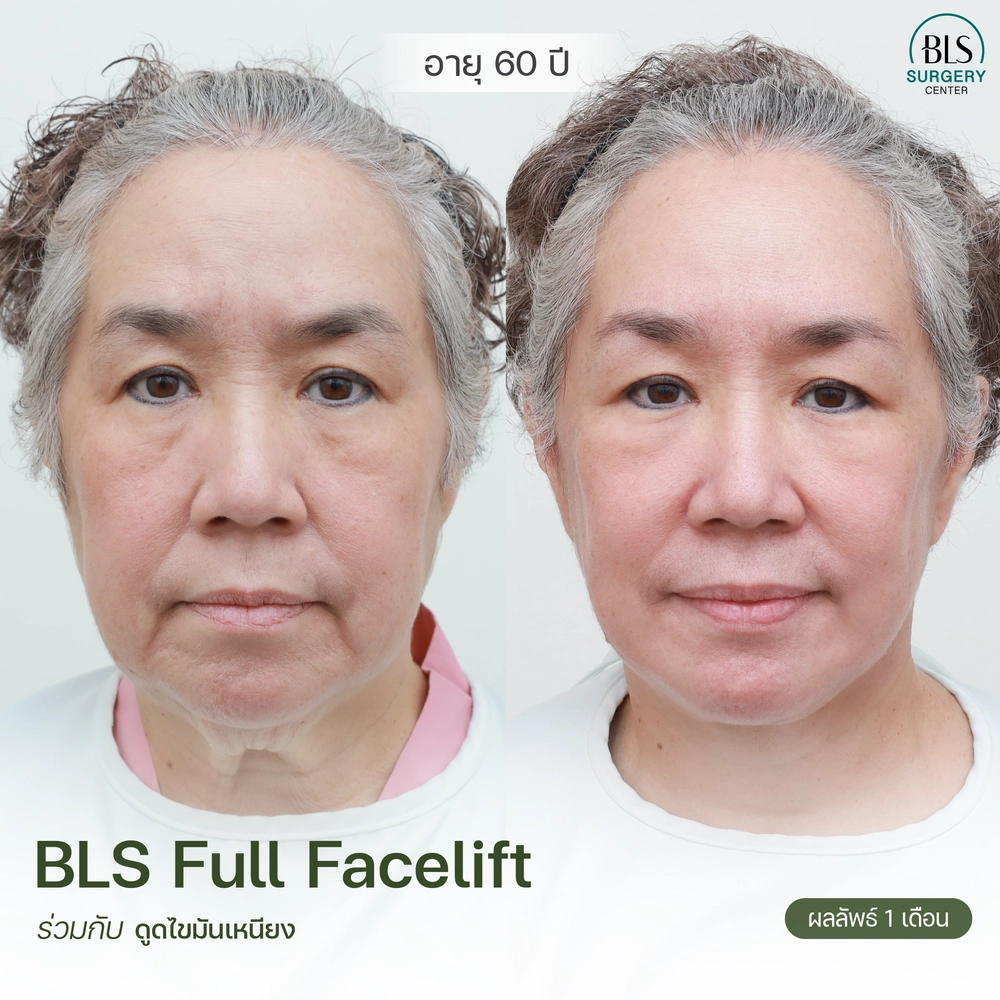 รวมรีวิวเคส Face Lift ยกกระชับหน้า ย้อนวัยเป็น 10 ปี โดยหมอเอิร์ธ